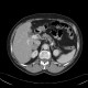Adrenal adenoma, contrast enhanced: CT - Computed tomography